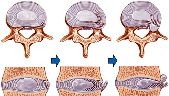 lesione della colonna vertebrale nell'osteocondrosi