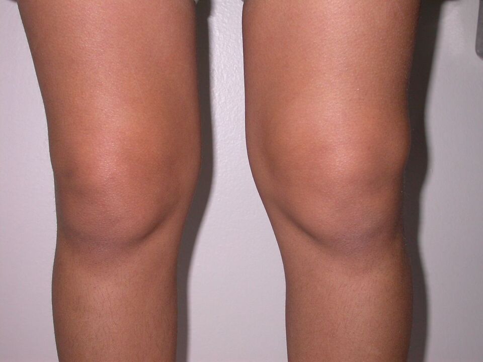 gonfiore del ginocchio dovuto all'artrosi