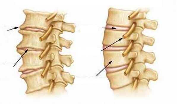 Cos'è l'osteocondrosi