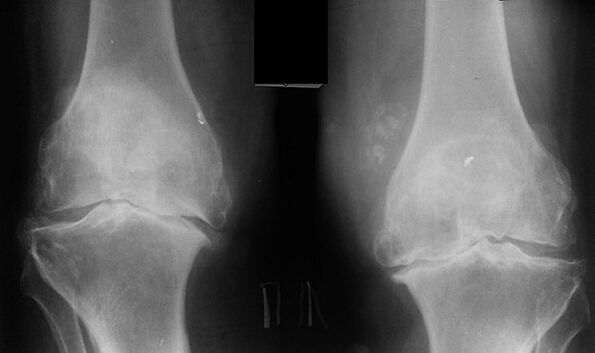 X -raggio come modo per diagnosticare l'artrosi dell'articolazione del ginocchio