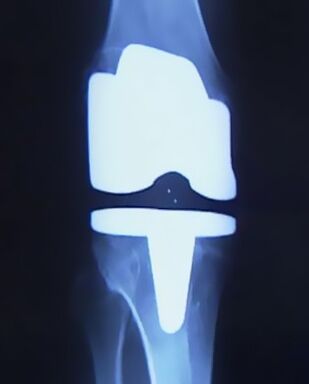 Radiografia di un ginocchio con una protesi artificiale dopo un intervento di sostituzione dell'articolazione
