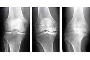 fasi di artrosi dell'articolazione su una radiografia