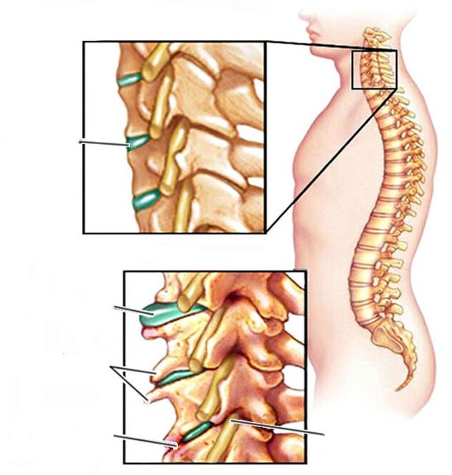 osteocondrosi e una colonna vertebrale cervicale sana