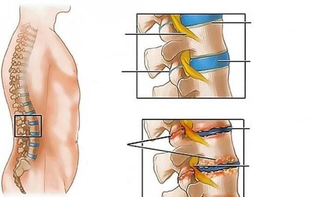 l'osteocondrosi della colonna lombare causa mal di schiena